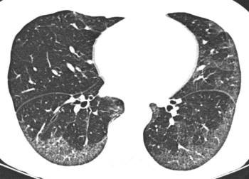 viêm phổi kẽ tế bào không đặc hiệu