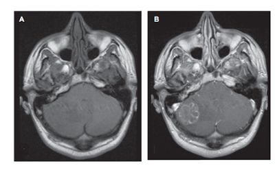 Hình 1. Phim MRI chuỗi xung T1 không tiêm đối quang (A) và có tiêm đối quang (B) cho thấy tổn thương tăng đối quang không đồng nhất ở tiểu não phải, tương thích với hình ảnh u di căn.