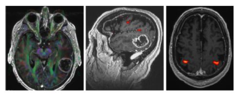 Hình 2. MRI chức năng xác định các dãi chất trắng (hình trái), vùng ngôn ngữ (hình giữa) và vùng vận động của tay (hình phải).
