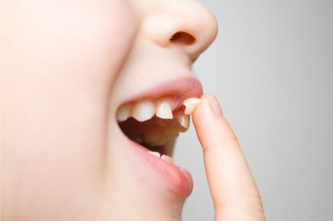 Nhổ răng sữa sớm có ảnh hưởng gì không?
