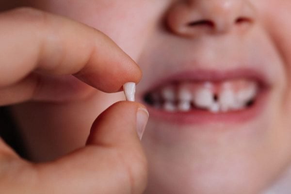 Nhổ răng sữa chưa lung lay có đau không?