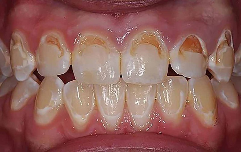răng thiếu canxi