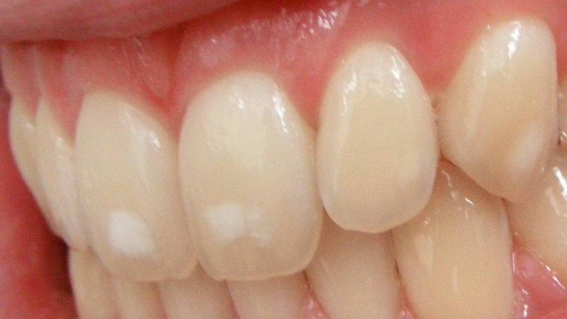 Cách chữa răng bị nhiễm fluor