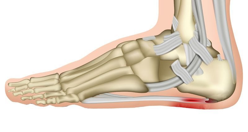 Heel pain due to plantar fasciitis: How is it treated?