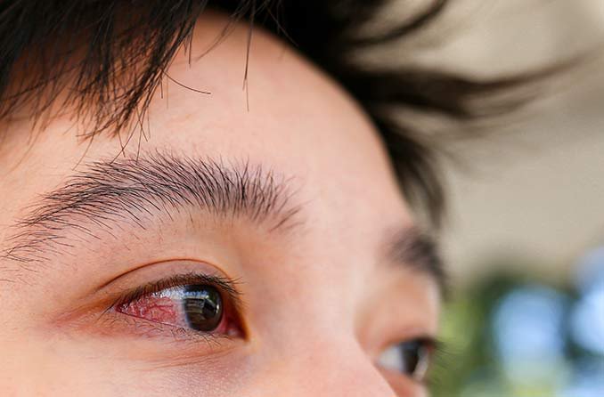 Viêm kết mạc mắt điều trị không khỏi