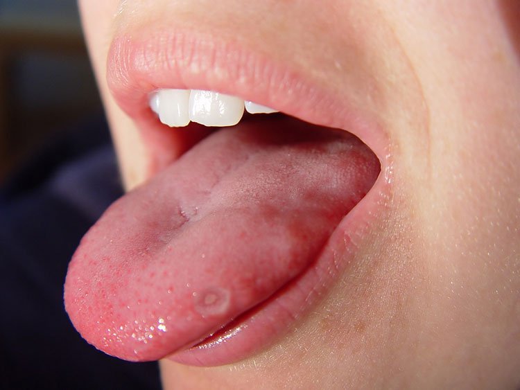 cách chữa nhiệt lưỡi