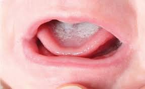 Cách trị trắng lưỡi ở trẻ sơ sinh hiệu quả