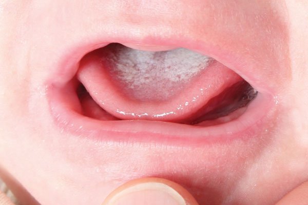 Trẻ 9 tháng tuổi biếng ăn kèm lưỡi bé bị trắng