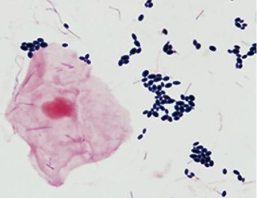 hinh-anh-nam-candida-soi-tuoi (2).png