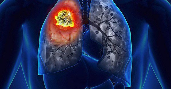 Ung thư phổi hạch trung thất chưa di căn