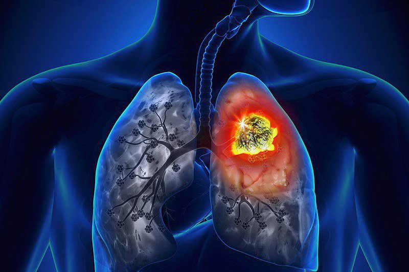 Phát hiện sớm ung thư phổi