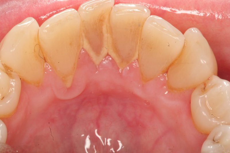 Các yếu tố gây tụt lợi chân răng