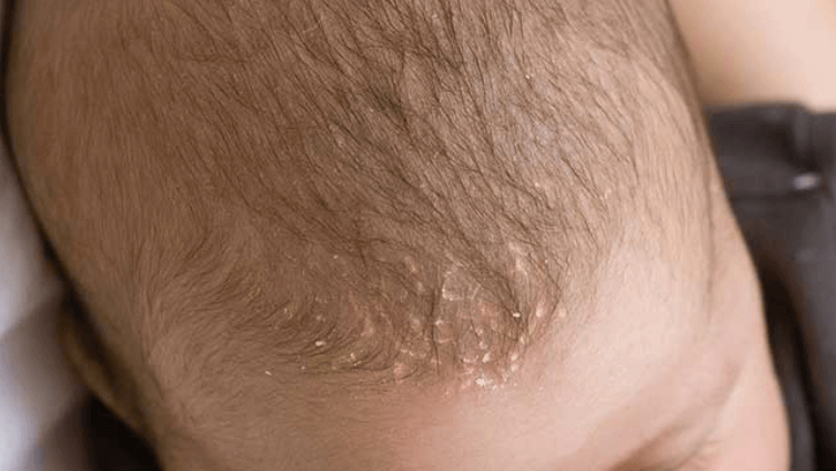 thuốc điều trị nấm da đầu ở trẻ em