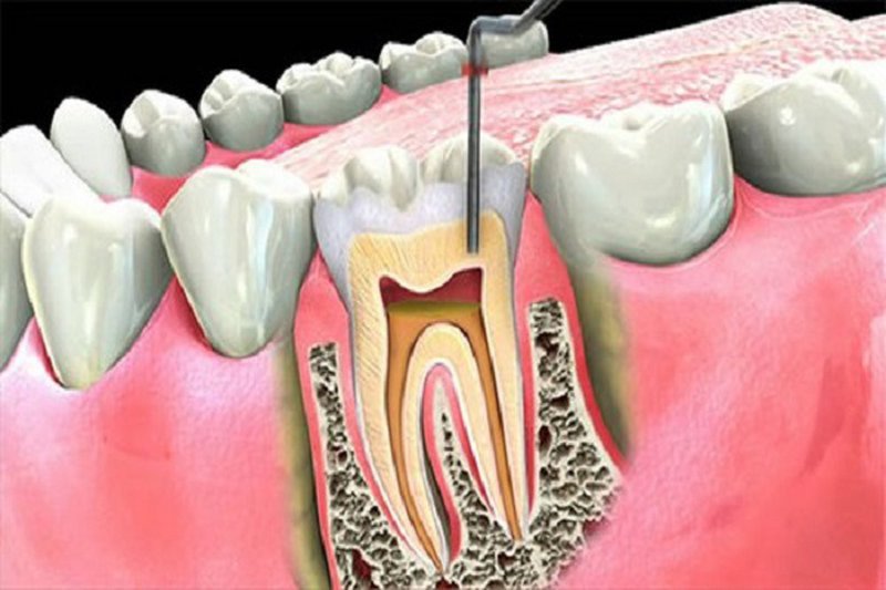 răng lấy tủy có bị tiêu xương không