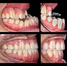 quy trình niềng răng khớp cắn ngược