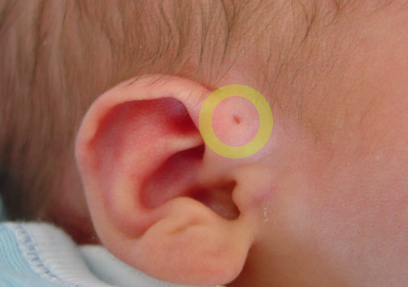 dị tật tai ở trẻ sơ sinh