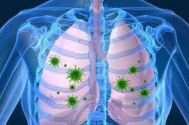 Chẩn đoán và điều trị bệnh viêm phổi do phế cầu