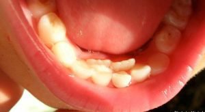 Hàm răng hỗn hợp ở trẻ nhỏ. ba mẹ cần chú ý đến việc cần nhổ răng sữa cho con hay chưa.