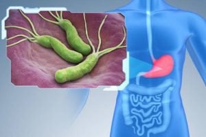 Helicobacter Pylori là một trong những yếu tố nguy cơ của viêm dạ dày