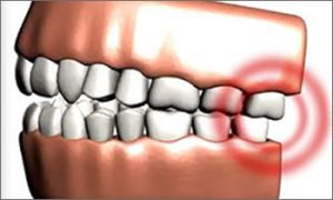 Răng là nguyên nhân chủ yếu gây ra đau hàm