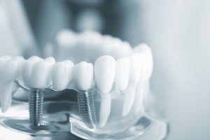 Răng Implant cũng cần chú ý chăm sóc để duy trì thời gian sử dụng