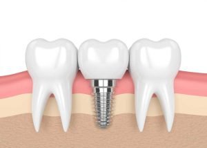 Implant là phương pháp phục hồi lại chức năng những chiếc răng đã mất