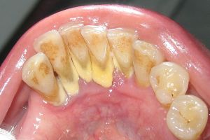 Cao răng gây nhiều tác hại đến sức khoẻ răng miệng