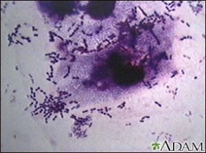hình ảnh vi khuẩn phế cầu gây bệnh viêm màng não do phế cầu