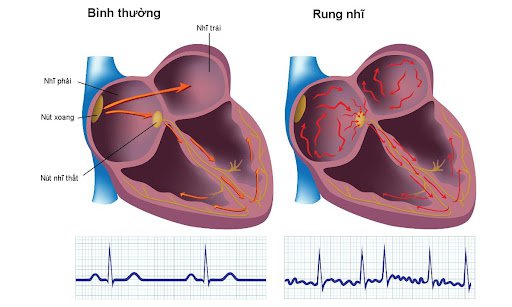 Hình bên trái: Tim ở trạng thái đập bình thường. Hình bên phải: Rung nhĩ gây rối loạn nhịp và tần số tim.