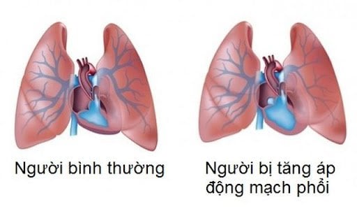 Tăng áp động mạch phổi