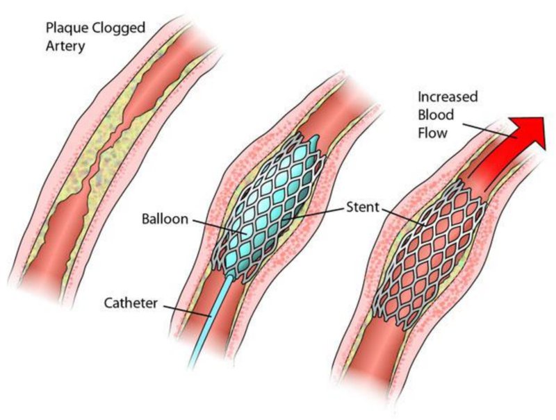 stent mạch vành