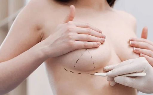 Phẫu thuật nâng ngực là phương pháp làm đẹp giúp cải thiện hình dáng, kích thước và độ săn chắc của vòng 1