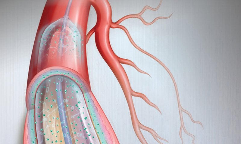 Minh họa bóng phủ thuốc động mạch vành