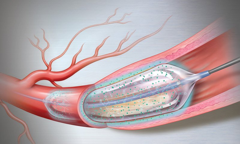 Quá trình bóng nong giải phóng thuốc trong động mạch vành