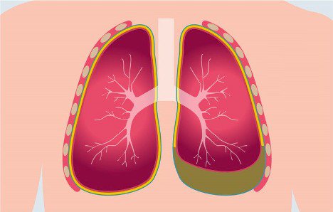 Viêm màng phổi là một trong các triệu chứng bệnh thấp tim