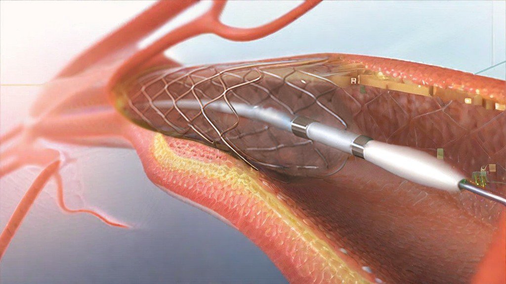 Nong mạch bằng stent để cải thiện lưu thông máu cho bệnh tim to