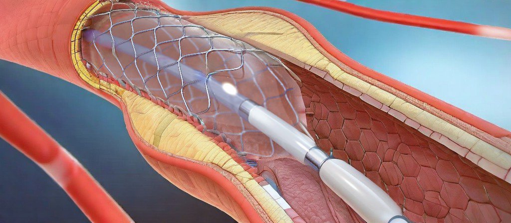 Đặt stent là phương pháp mở rộng mạch vành, tăng lưu lượng máu