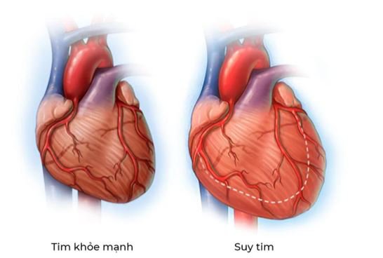 Suy tim là một biến chứng nguy hiểm của bệnh động mạch vành