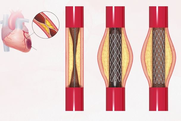 Hình ảnh đặt stent mạch vành để mở rộng lòng mạch và cải thiện lưu thông máu