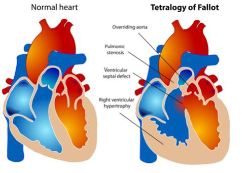 Tứ chứng Fallot là hội chứng tim bẩm sinh phức tạp và phổ biến nhất