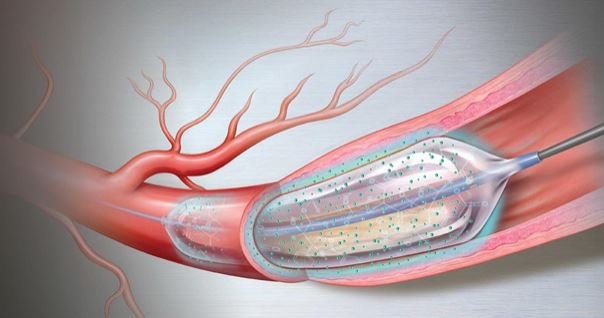 Phương pháp nong động mạch vành bằng bóng phủ thuốc giúp giảm nguy cơ huyết khối cấp trong lòng stent
