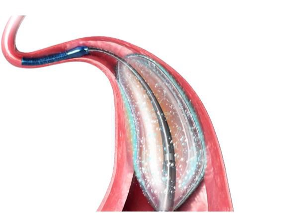 Nong mạch vành và đặt stent ít xâm lấn hơn so với phẫu thuật bắc cầu mạch vành