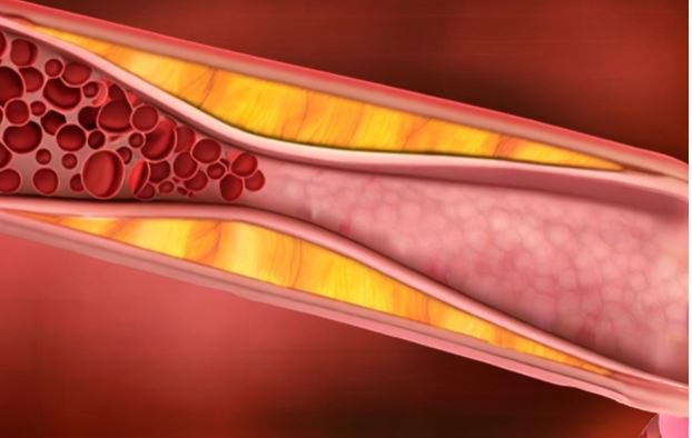 Bệnh nhân bị bệnh mạch vành sẽ xuất hiện các mảng xơ vữa bám trên thành mạch làm hẹp mạch máu