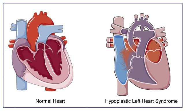 Hội chứng thiểu sản tim trái là do các cấu trúc của phần bên trái của tim - bao gồm van tim trái, thất trái và các mạch máu chính như động mạch chủ - không phát triển đầy đủ    (Nguồn: www.sciencedirect.com)