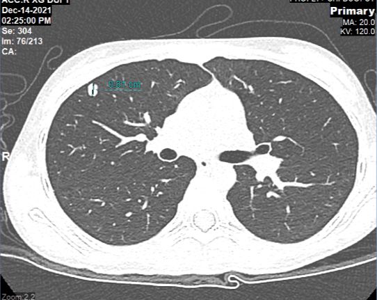Hình chụp CT phối của cháu K.T phát hiện khối u di căn phổi sau 1 năm phẫu thuật cắt bỏ u khớp gối