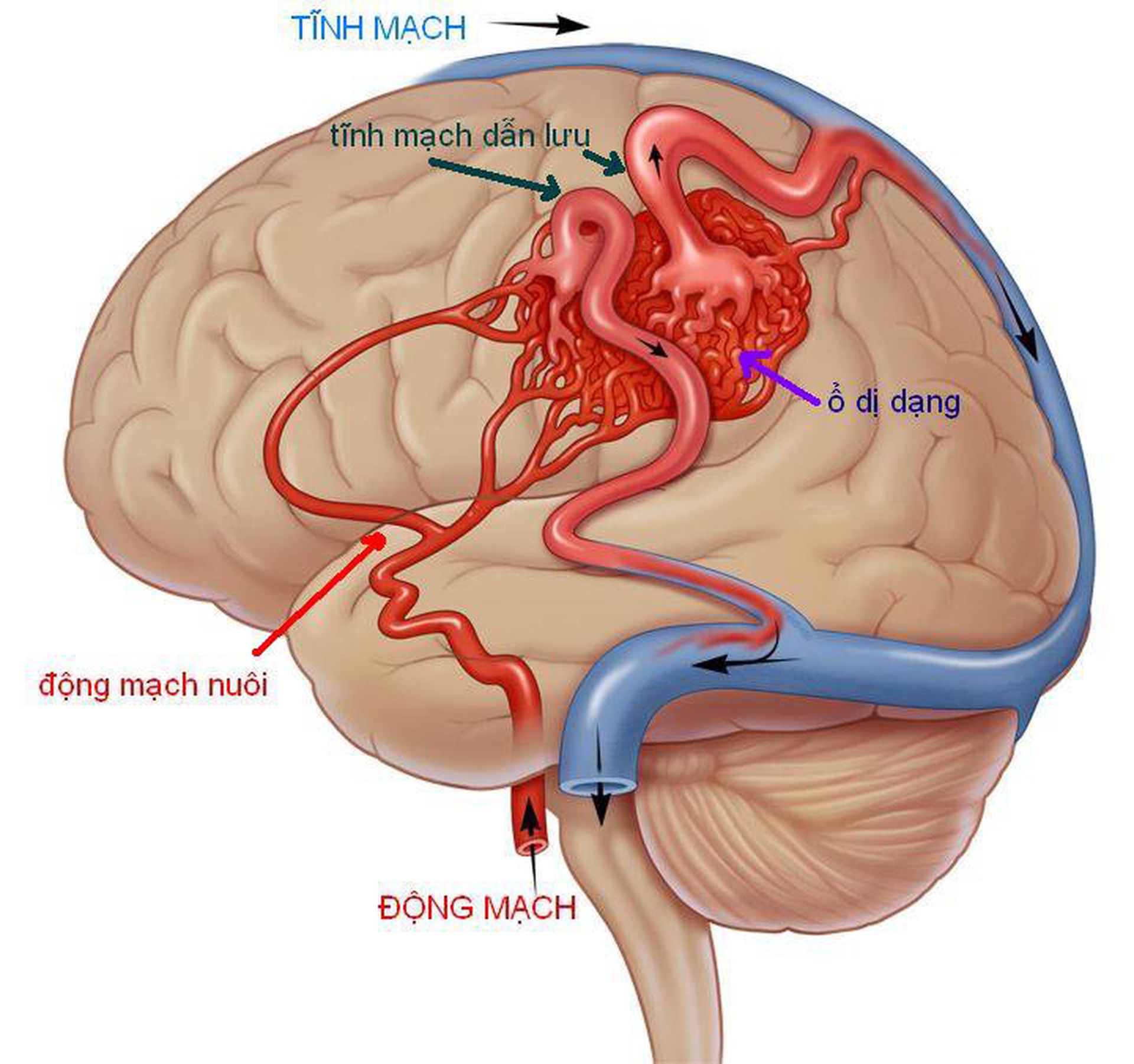 Сосудистая аномалия. Мальформация сосудов головного мозга. АВМ мальформация сосудов головного мозга. Артерия венозная мальформация головного мозга. Эмболизация АВМ сосудов головного мозга.