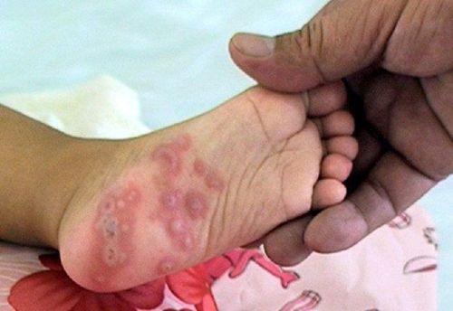 Hand, Foot, and Mouth Disease Continues to Surge: Beware of Severe Complications  
