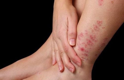 Điều trị viêm da cơ địa ở Cần Thơ