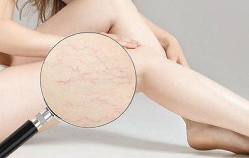 Do puberty stretch marks go away?