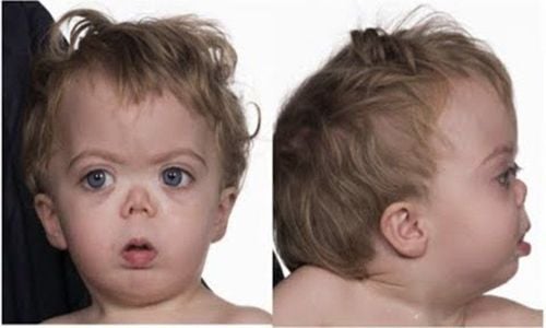 What is Stickler Syndrome?